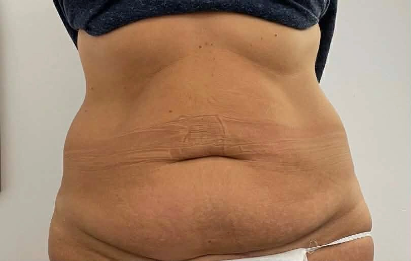 Ciało przed zabiegiem